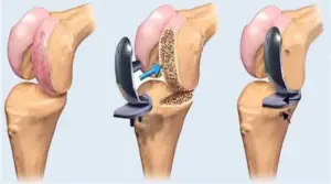 Knee replacement surgery