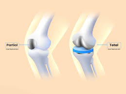 Knee replacement surgery in Bhopal