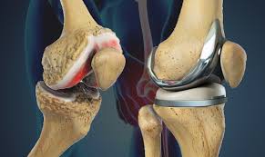 Knee replacement surgery in Chhatarpur