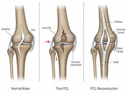 Ligament Tear Treatment In Nagpur