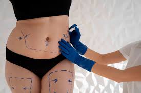 Liposuction in Gaurela-Pendra-Marwahi
