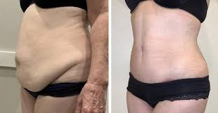 Liposuction in Jabalpur