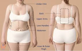 Liposuction in Jashpur