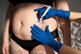 Liposuction in Kabirdham