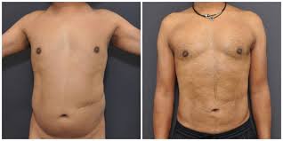 Liposuction in Dantewada