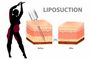Liposuction in Akola