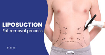 Liposuction in yavatmal