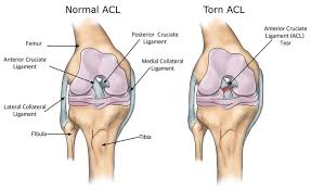 Pcl Injury Surgeon In Nagpur