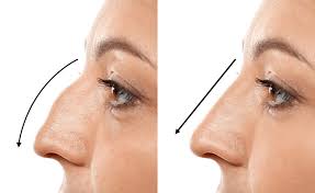Rhinoplasty In Dewas