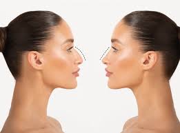 Rhinoplasty In Gwalior