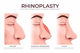 Rhinoplasty In Morena