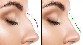 Rhinoplasty in Dantewada