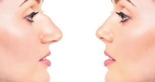 Rhinoplasty in Durg
