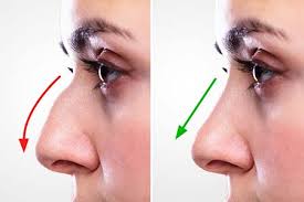 Rhinoplasty in Nagpur