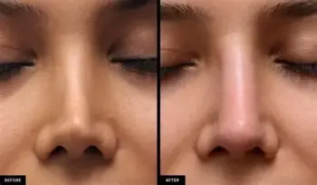 Rhinoplasty in chandrapur