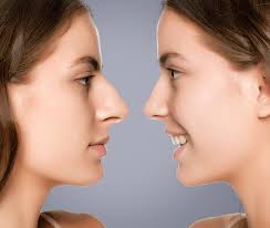 Rhinoplasty in Janjgir-Champa