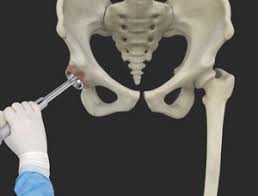 Robotic Hip Replacement in Gwalior