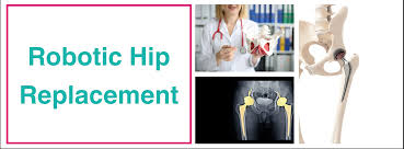 Robotic Hip Replacement in Baloda Bazar‑Bhatapara