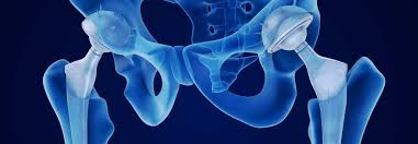 Robotic Hip Replacement in Bastar