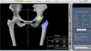 Robotic Hip Replacement in Kabirdham