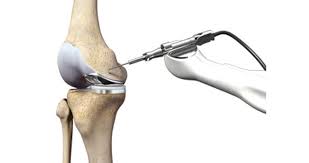 Robotic Joint Replacement In Jabalpur