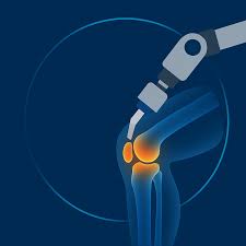 Robotic Joint Replacement in Dhamtari