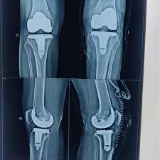 Robotic Joint Replacement in Kanker
