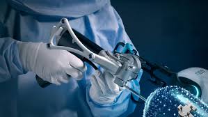 Robotic Knee Replacement in Kanker