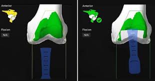 Robotic Knee Replacement in Korba