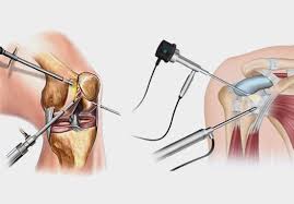 Robotic Knee Replacement in Mungeli