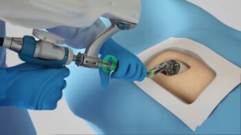 Robotic hip replacement