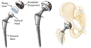 Robotic hip replacement in Ujjain