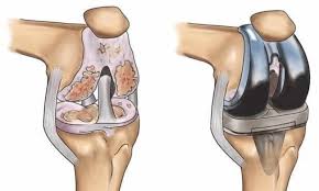 Robotic joint replacement in Indore