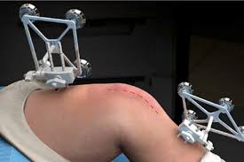 Robotic knee replacement in Jabalpur