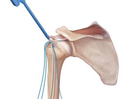 Rotator Cuff Surgeon In Gondia