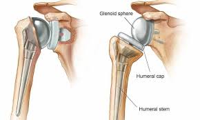 Shoulder Replacement Surgeon In Nagpur