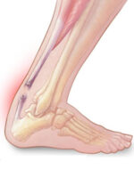 Tendon injury