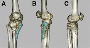 Tibial Condylar Valgus Osteotomy (Tcvo) In Nagpur
