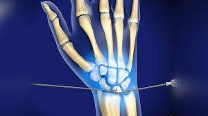 Wrist Arthroscopy in Nagpur