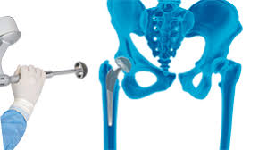 robotic-hip-replacement-in-satna