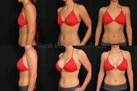 Breast Augmentation In Neemach