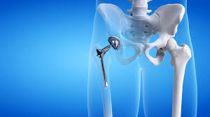 Hip Replacement Surgery In Itarsi