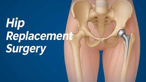 Hip Replacement Surgery In Nagda