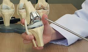 Knee Replacement Surgery in Surguja