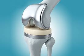 Knee replacement surgery in Shajapur