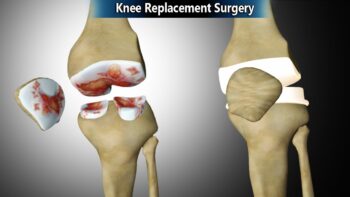 Knee replacement surgery in adilabad