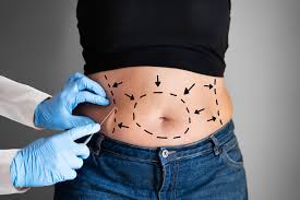 Liposuction In Damoh