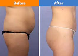 Liposuction in Mungeli