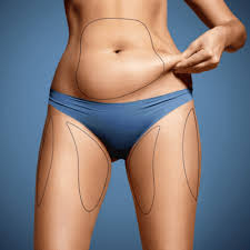 Liposuction in Raipur