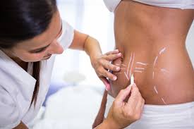 Liposuction in Sarangarh-Bilaigarh